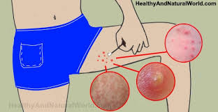 Cleansing your thighs cleansing is the best place to start when wanting to eradicate these unsightly inner thigh blackheads. Effective Ways To Get Rid Of Bumps On Inner Thigh Backed By Science