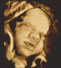 Ultrasound is a type of diagnostic medical imaging system which uses sound waves above the threshold of hearing to capture live images from within your body. 4d Pregnancy Bonding Ultrasound The Ultrasound Clinic