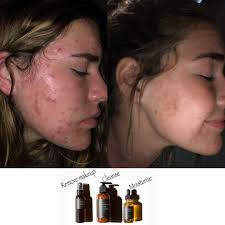 The fountain of youth collection is back in stock! ⛲️❤️  https://pomifera.com/MemberToolsDotNet/ShoppingCartV4/MainCartv4.aspx?MG=7  This is the system that has completely changed my skin, improved my redness  and rosacea, and healed my itchy, raw face.