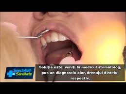 Abcesul dentar trebuie prezentat imediat dentistului, deoarece acesta nu se va vindeca de la sine. Abcesul Dentar O Urgenta Stomatologica Youtube