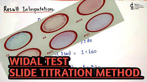 Maybe you would like to learn more about one of these? Widal Test Slide Titration Dilution Method Procedure And Result Interpretation In An Easy Way Youtube