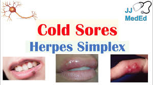 Viral shedding has been detected before, during, and after the appearance of clinical lesions in patients with recurrent oral symptoms, such as mild pharyngitis and erythema of the oral mucosa, occur with. Cold Sores Oral Herpes Causes Signs Symptoms Treatment Youtube