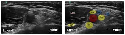 Image result for Axillary Nerve Block
