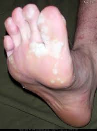 · duct tape is one home remedy. Medpix Case Plantar Warts