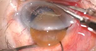 Image result for Cataract Extraction