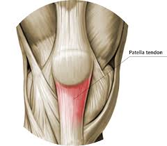 Ligaments connect one bone to another, while tendons connect muscle to bone. Patella Tendon Rupture Core Em
