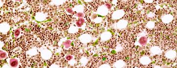 Check spelling or type a new query. Bone Marrow Aspiration