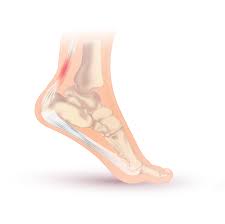 Achilles Tendinitis Wikipedia