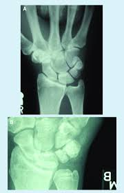A Triquetral Fracture This Is The Most Common Variant Of Triquetral Download Scientific Diagram Triquetral boneleft hand anterior view (palmar view). a triquetral fracture this is the