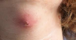 Image result for Skin Abscess
