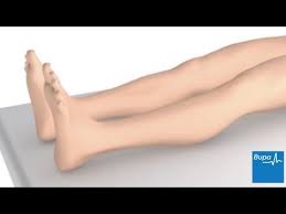How Varicose Vein Ligation And Stripping Is Carried Out Youtube