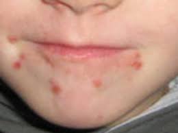 Order picrnovirales family picornaviridae genus aphthovirus species bovine rhinitis virus. Remedies For Hand Foot Mouth Disease Homeopathy Plus