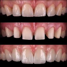 Diastema Closure With Six Ips E Max Press Veneers Thanks To Cdt Sibelkucukel For Lab Work Dis Arasi Bosluklarinin Alti Adet Ips E Dis Disle Ilgili Instagram