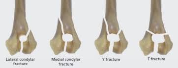 Image result for Lateral Condyle Fracture