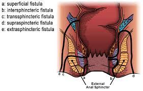 Obstetric fistula is a childbirth injury that destroys a woman's life. Abscess And Fistula Expanded Information Ascrs