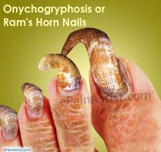 onychogryphosis or ram s horn nails