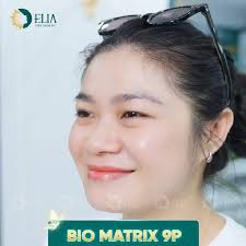 Tổng hợp tình trạng nên sử dụng liệu pháp trẻ hóa sinh học Bio Matrix 9P  tại viện thẩm mỹ Elia