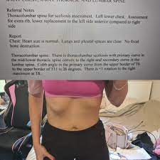 I just didn't feel right. Update Reddit Called My Scoliosis With My Ribs Went And Got An Xray And The Doctor Confirmed Ive Got Physiotherapy Tomorrow Thanks Reddit Medical