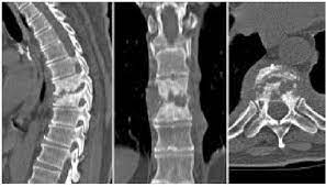 Pyogenic Infection Of Spine Bone And Spine