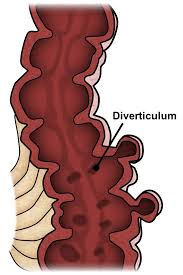 In a colonoscopy (colonoscopy), the large intestine is examined through the anus. Diverticular Disease Ascrs