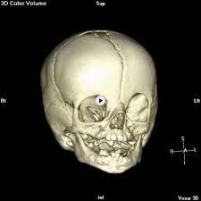 لتشوهات الرأس