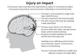 Image result for Concussion Symptom Checklist