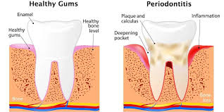 Periodontitis is a set of inflammatory diseases affecting the periodontium (i.e. Stages Of Periodontal Disease Joseph Lichter Dds Pc Dental Office Brooklyn Ny