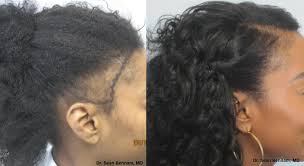 Source high quality products in hundreds of categories wholesale direct from china. African American Hair Transplants By Dr Sean Behnam