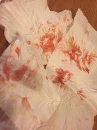 Check spelling or type a new query. Intermittent Bleeding For One Week 5 6 Weeks Please Have A Look Picture