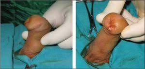 Doğumdan hemen sonra bir ürolog tarafından görülmeli. Hipospadias Ameliyatlarindaki Tedavi Yaklasimlari Prof Dr Y Tarkan Soygur