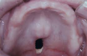 Image result for Tertiary Syphilis