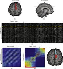 Connectivity Fingerprinting Of Gray Matter Sciencedirect