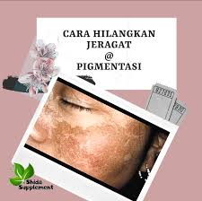 Seseorang yang menggunakan obat rumahan sebagai cara menghilangkan jerawat, pada. Cara Hilangkan Jeragat Pigmentasi Shidarahmat