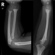 Fraying Splaying And Cupping Of The Distal Radial And Ulnar Metaphyses Widening Of The Physis Findings C Radiology Ultrasound Technician Pediatric Radiology