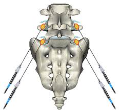 Image result for Radiofrequency Surgery