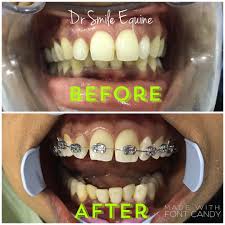 Harga braces meningkat saban tahun. Pemakaian Braces Klinik Pergigian Dr Smile Taman Equine Facebook
