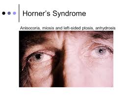 Treat anhidrosis, with effective natural cures like baking soda in a glass of water, cucumber juice, and water with sea anhidrosis remedies. Anisocoria And Horner S Syndrome By Sarah Foust
