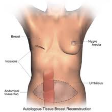Buy the best and latest silastic sealant on banggood.com offer the quality silastic sealant on sale with worldwide free shipping. Breast Reconstruction Wikipedia