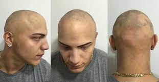 Its causes are unclear, but believed to be autoimmune. What Causes Alopecia Alopecia Treatments Alopecia Help Skalp
