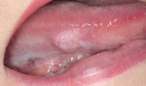 Maybe you would like to learn more about one of these? Racgp A Keratinised Lump On The Lateral Surface Of The Tongue
