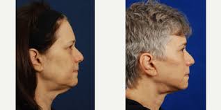 Tom D. Wang, MD, FACS, Board Certified Facial Plastic Surgeon