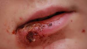What are the signs & symptoms of mrsa? Mrsa Staph Infection Pictures Symptoms Treatment And Prevention