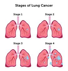 Image result for Lung Cancer