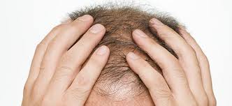 They are dedicated to only you that day. Hair Loss Condition Ut Southwestern Medical Center