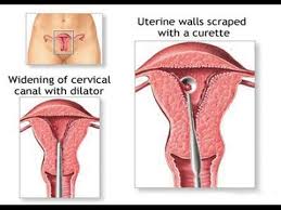 Image result for amenorrhea