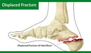 (annoyed) i was just trying to get home. Calcaneus Fracture Or Broken Heel Treatment Recovery Symptoms Types Causes