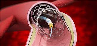 A road that passes around something, such as a residential area. Neue Analyse Spricht Fur Bypass Statt Stent