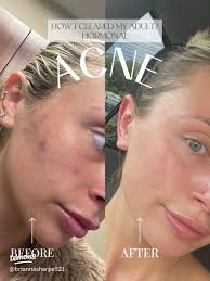How I Cleared My Adult Acne: My Journey to Clear Skin