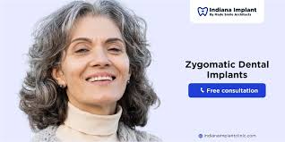 Zygomatic Dental Implants: The Solution for Severe Bone Loss