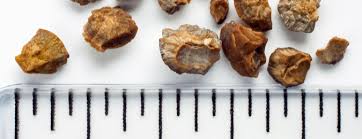 Learn about kidney stones and their symptoms, causes, types, and treatment. How Long Does It Take To Pass A Kidney Stone Certified Online Pharmacy
